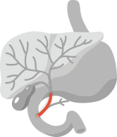 Image of the liver, stomach, gallbladder and bile duct with the bile ducts outside the liver highlighted to show Extrahepatic cholangiocarcinoma, which starts in the bile ducts outside the liver