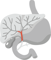 Image of the liver, stomach, gallbladder, and bile duct with the bile ducts outside the liver highlighted to show Perihilar cholangiocarcinoma, which starts in the bile ducts just outside the liver