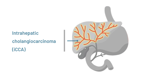 A graphic represening intraheptic cholangiocarcinoma.